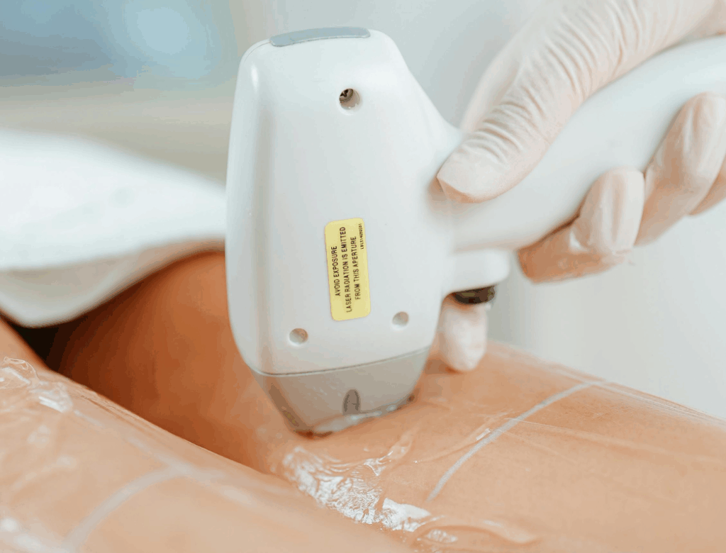 Diodenlaser Haarentfernung