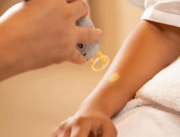 Welche Laser-Haarentfernung ist die beste?