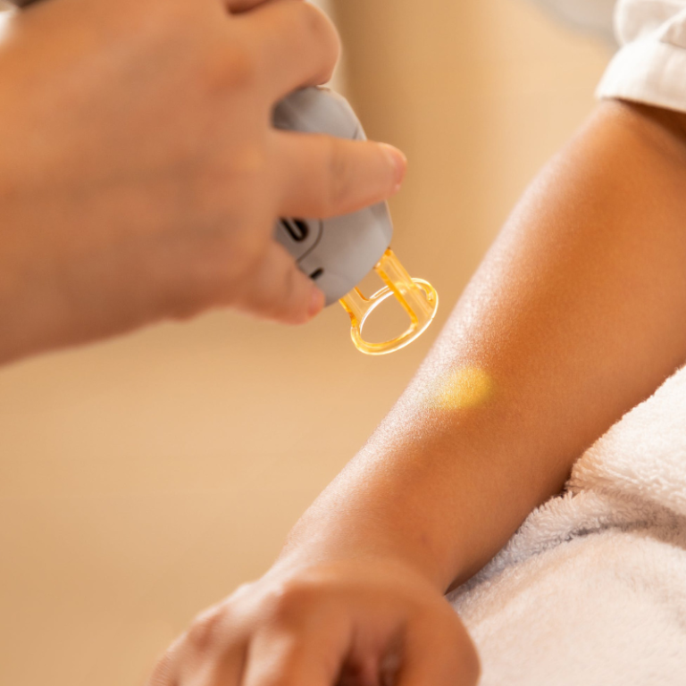 Welche Laser-Haarentfernung ist die beste?